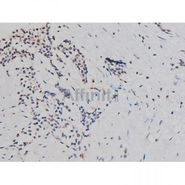 Phospho-Tau (Thr205)[Thr522] Antibody - AF3150 at 1/200 staining Human bladder cancer tissue sections by IHC-P.